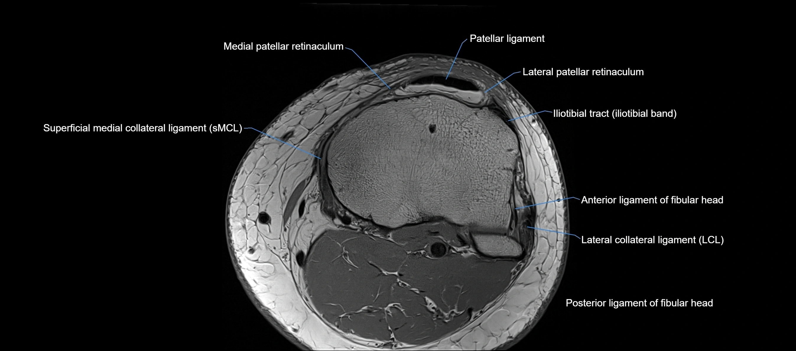 MRI Knee axial  ligaments cross sectional anatomy 3T  radiology  image-img-03001-00038.webp